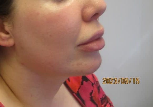 2 - After necktite liposuction - 8 weeks after