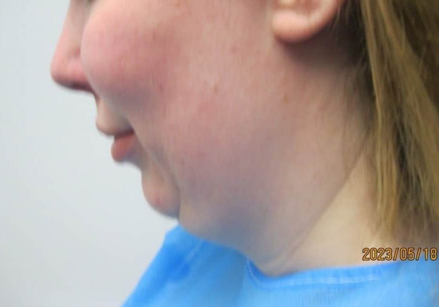 2 - before Necktite liposuction - side