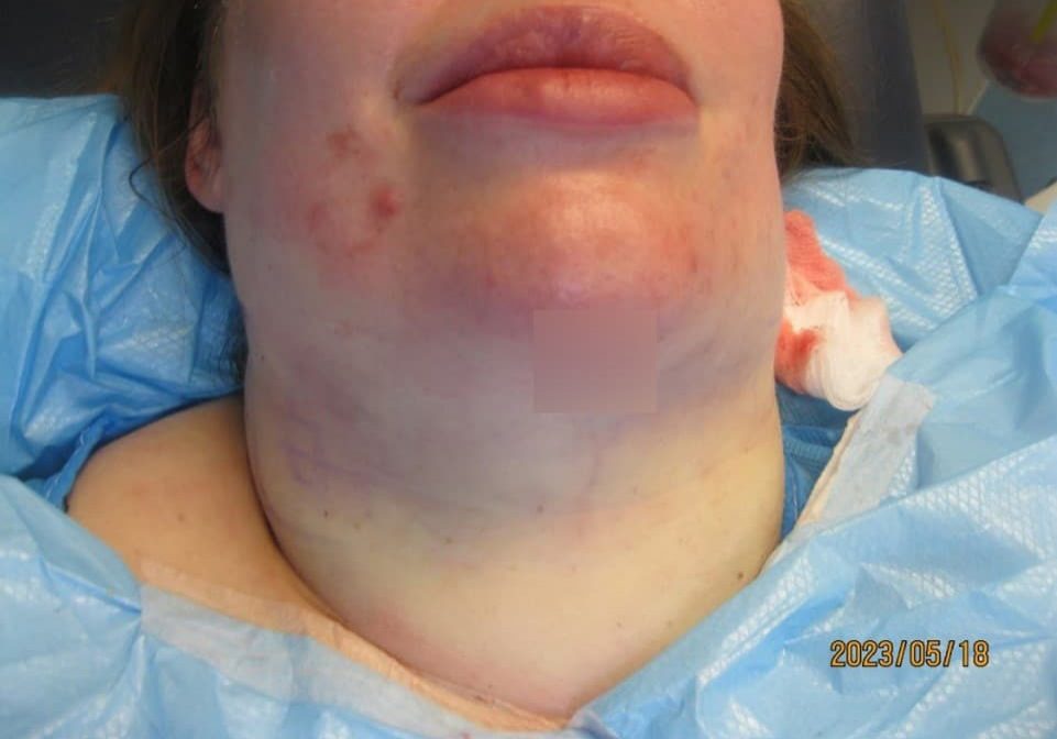 2 - immediately After necktite liposuction - front