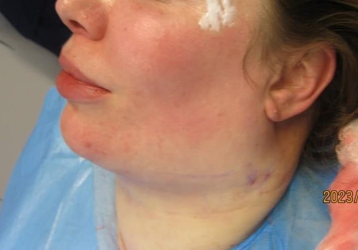 2 - immediately After necktite liposuction - side