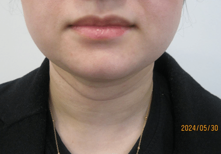 3 - After necktite liposuction - front 3 - After necktite liposuction - front