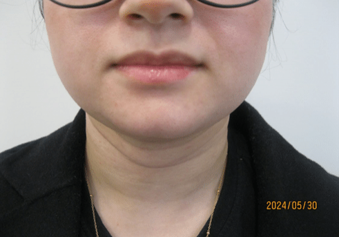 3 - After necktite liposuction - front