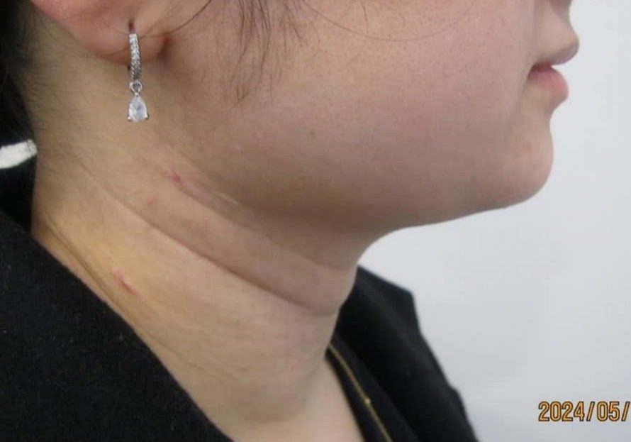 3 - After necktite liposuction - side 2 3 - After necktite liposuction - side 2