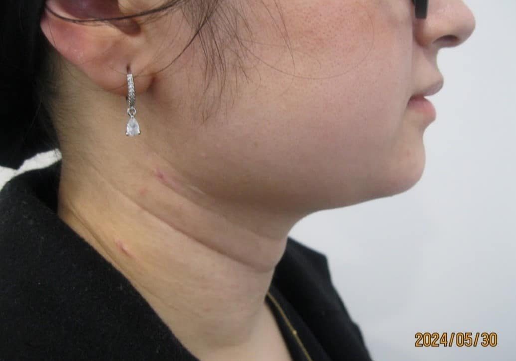 3 - After necktite liposuction - side 2