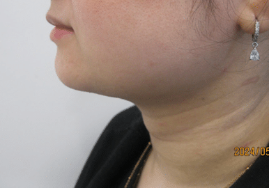 3 - After necktite liposuction - side 3 - After necktite liposuction - side