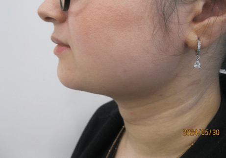 3 - After necktite liposuction - side