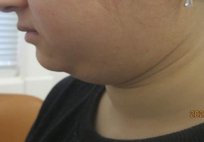 3 - before necktite liposuction - side 3 - before necktite liposuction - side