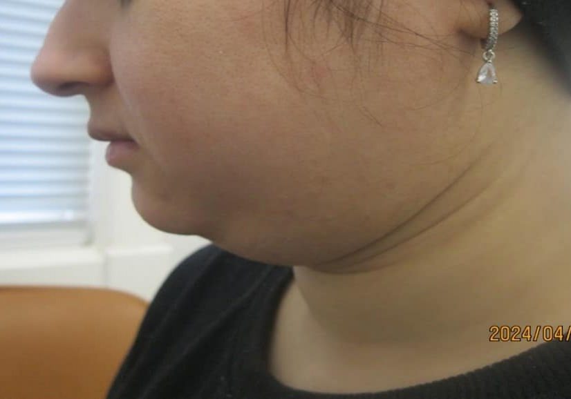 3 - before necktite liposuction - side