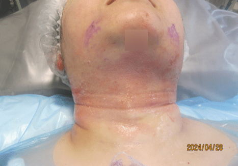 3 - immediately after necktite liposuction - front 2