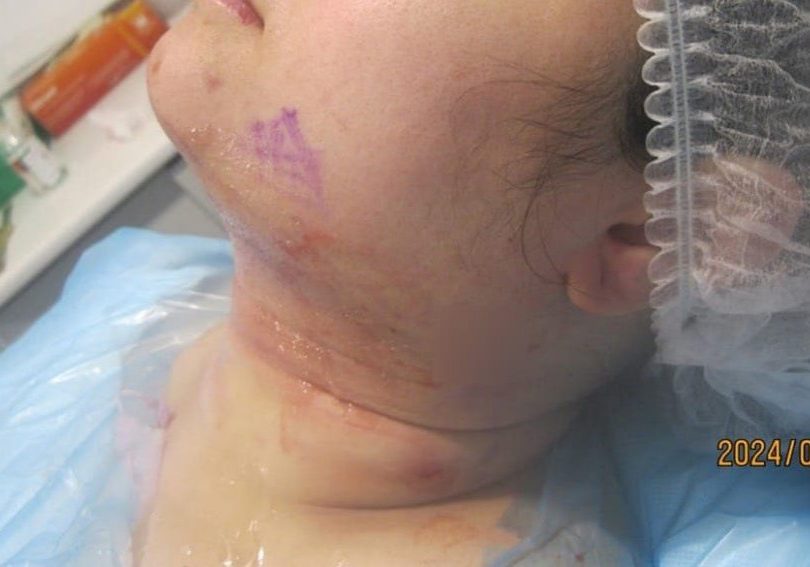 3 - immediately after necktite liposuction - front 3 - immediately after necktite liposuction - front