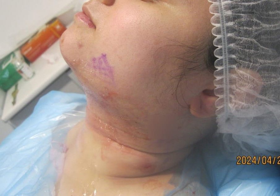 3 - immediately after necktite liposuction - front