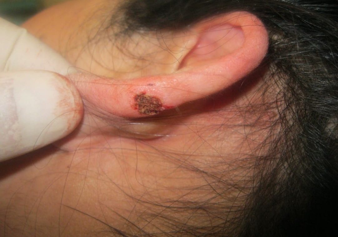 3 - keloid treatment on ear - after