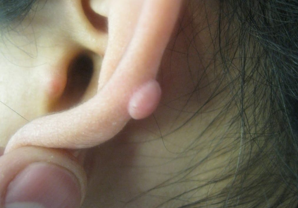 keloid treatment on lady's ear