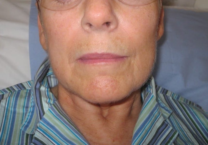 After necktite liposuction - front