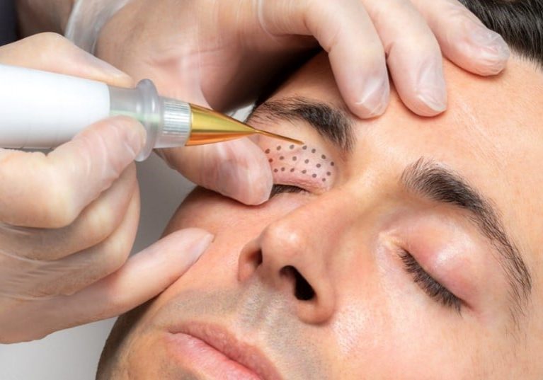 Eye lift treatment in Solihull