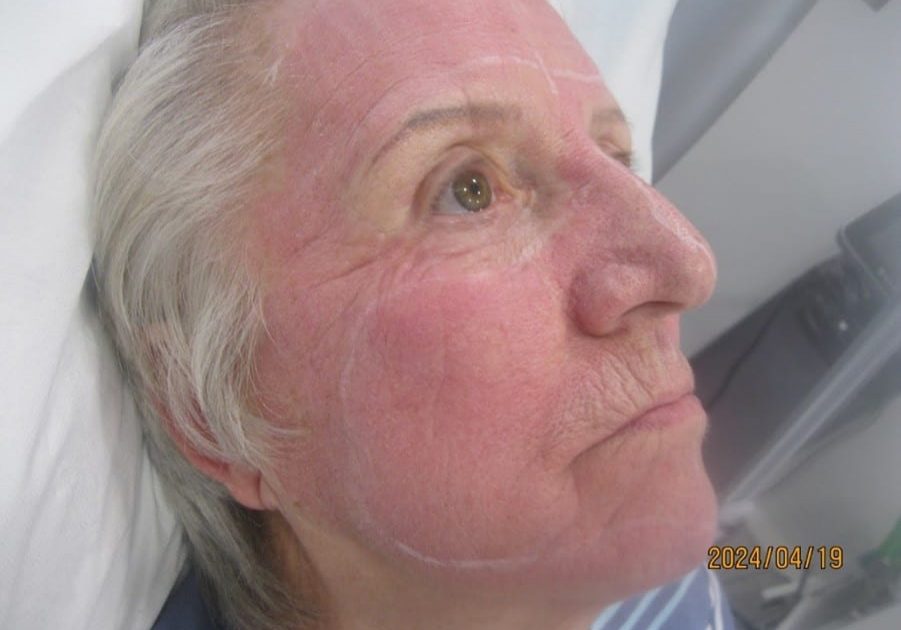 Immediately after fractional co2 laser resurfacing