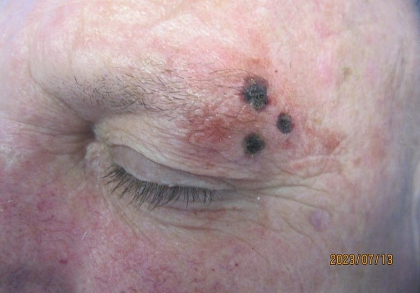 After Laser Ablation of Warty Skin Lesions Using Continuous C02 Laser