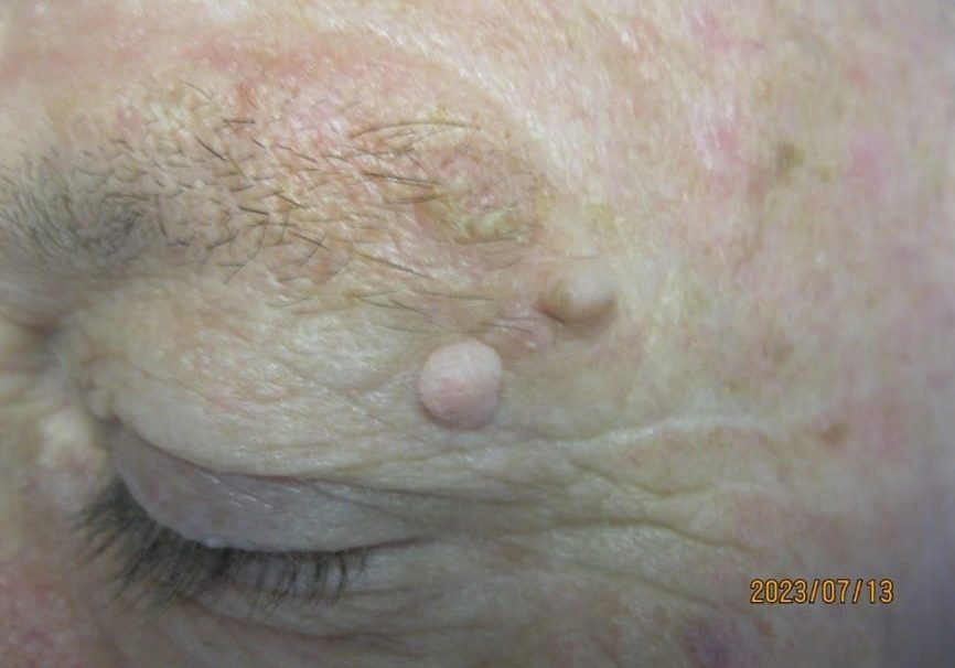 Before Laser Ablation of Warty Skin Lesions Using Continuous C02 Laser