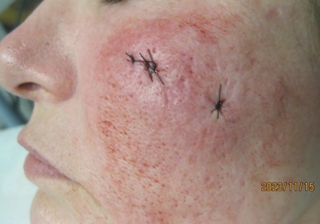 After Surgical Excision of Acne Scarring