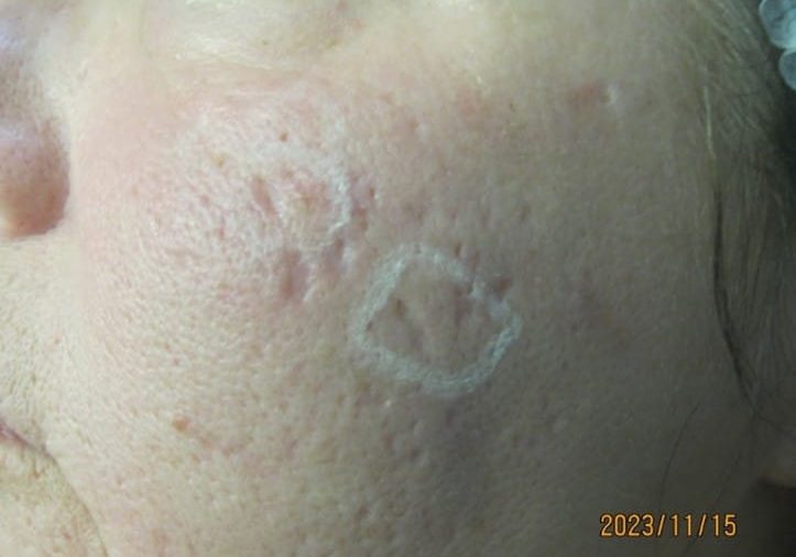 Before Surgical Excision of Acne Scarring