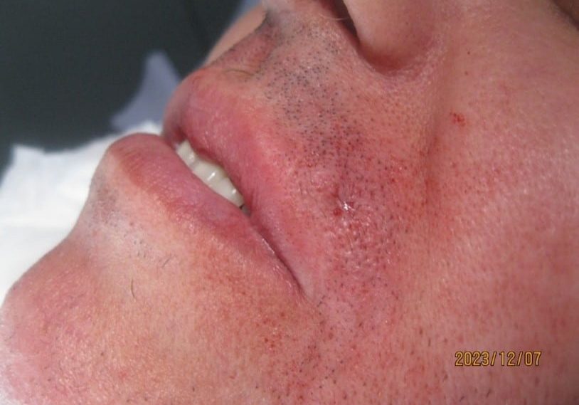 After Removal of Sebaceous Cyst on Upper Lip