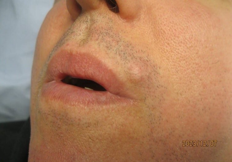 Before Removal of Sebaceous Cyst on Upper Lip