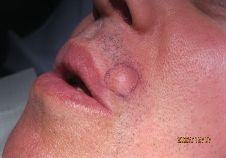 Before Removal of Sebaceous Cyst on Upper Lip