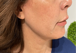 endolaser after 1 Solihull patient results after endolaser treatment, 3 months later