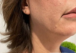 endolaser before 1 Solihull patient before endolaser treatment
