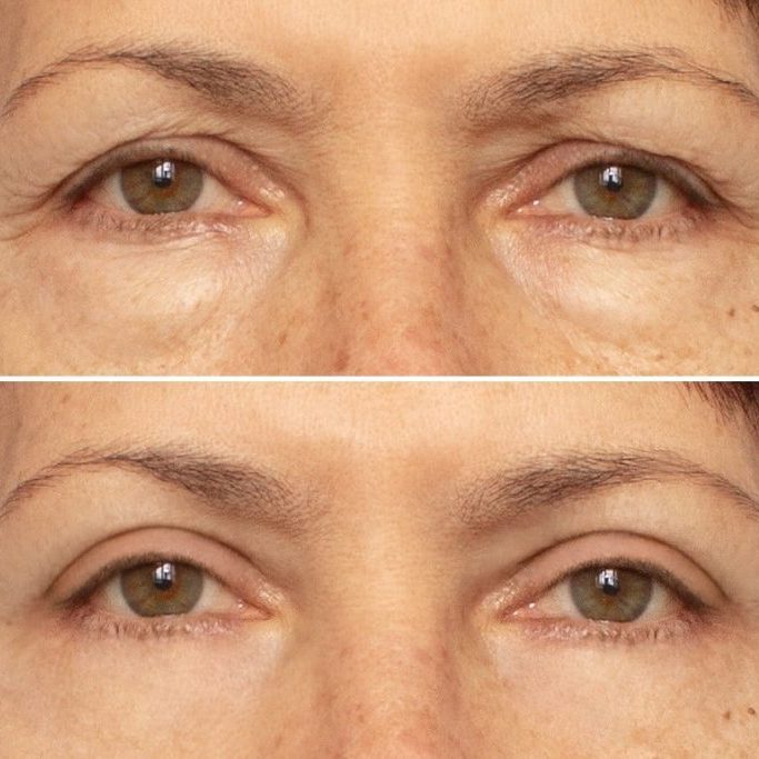 eye-bag-treatment-before-after