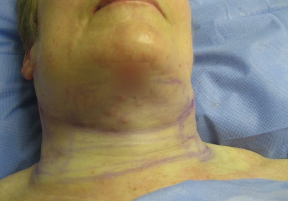 immediatelly After necktite liposuction - front