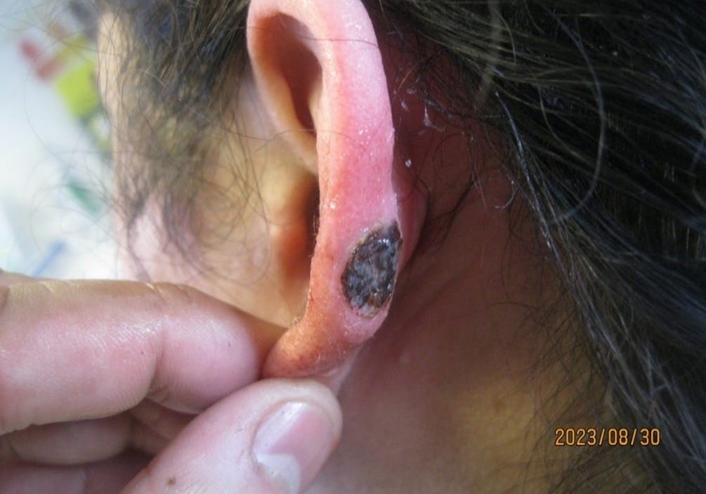 keloid scar treatment in the back of the ear - after