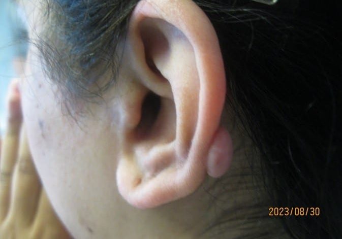 keloid scar treatment in the back of the ear - before